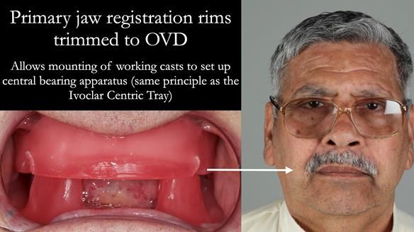 Finlay's Newsletter 62 provision of extractions and metal based complete dentures for Rafique