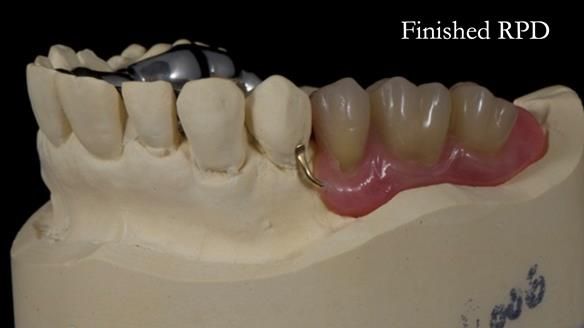 Finlay's Newsletter 64 case study - provision of a Kennedy class 2 metal based Scandinavian RPD for Ian