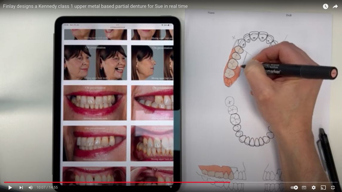 Finlay designs a Kennedy class 1 upper metal based partial denture for Sue in real time.