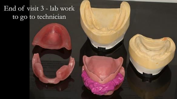 Newsletter 75: Marion’s case - Step-by-step complete denture workflow