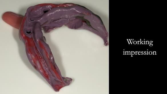 Close fitting tray - where the tray shows through the impression material is not a problem because the tray has been made to fit the accurate primary cast.