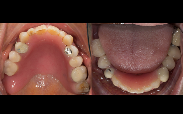 Figure 39 Immediate dentures fitted - no gaps between collets and teeth. Schottlander Enigmalife teeth.