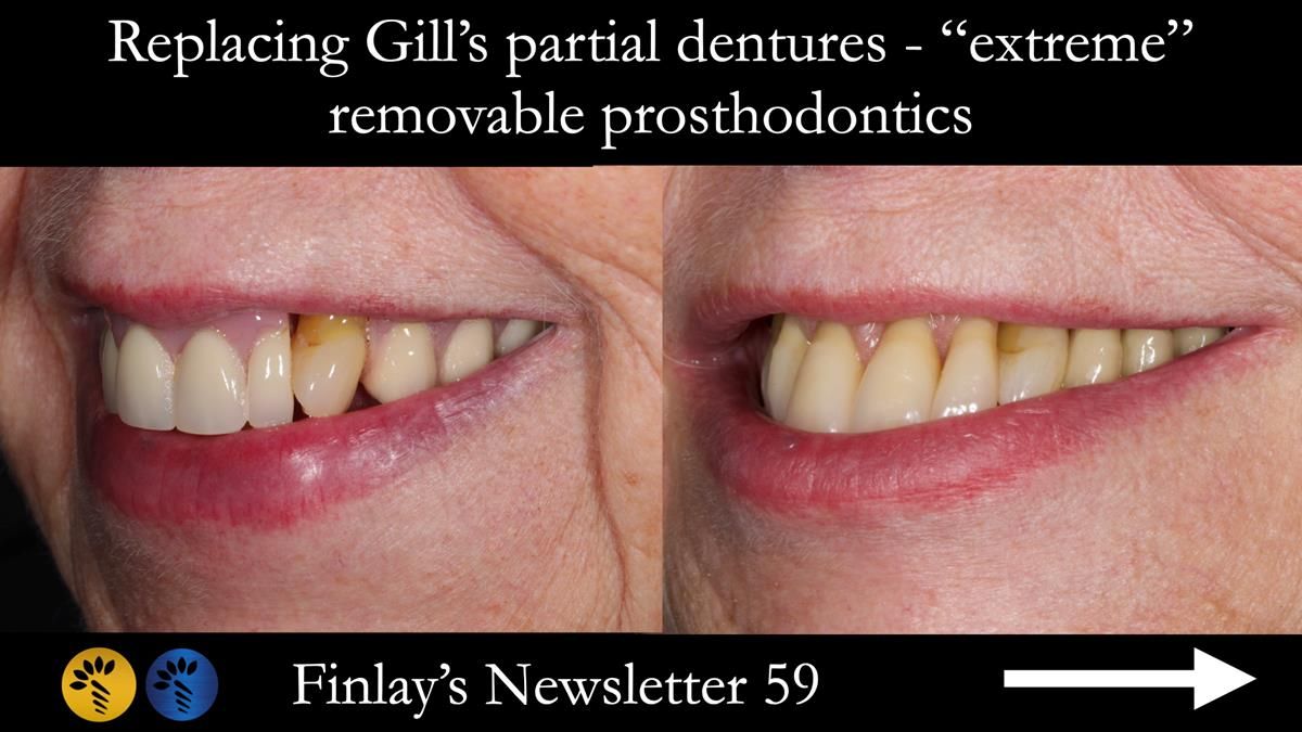 Finlay's Newsletter 59 Ultra hard partial dentures made for Gill