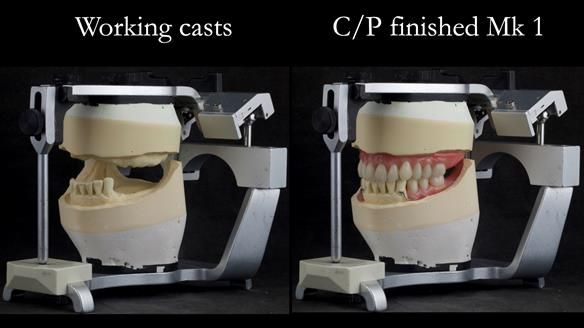 Newsletter 52 Managing Jo’s failing dentition with extractions and Mk 1/Mk 2 complete upper dentures and lower partial dentures FULL PROTOCOL