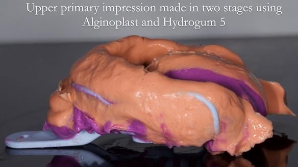 Finlay's Newsletter 64 case study - provision of a Kennedy class 2 metal based Scandinavian RPD for Ian