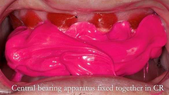 Managing poor implant positioning with complete dentures and Locator attachments - full protocol Newsletter 41