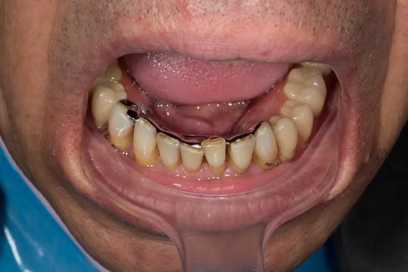 Figure 100 Mk 2 mandibular denture try in - teeth in wax