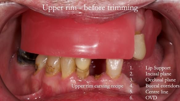 Newsletter 55 Provision of metal based partial dentures for Zephyrine with a repaired cleft lip and palate