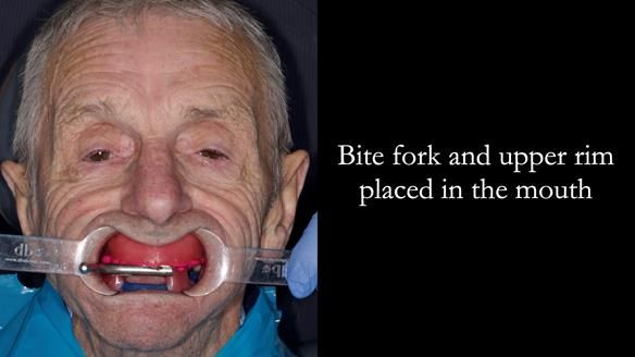 Newsletter 80 - Gordon’s dentures: the one case in 1,000 where my technique failed