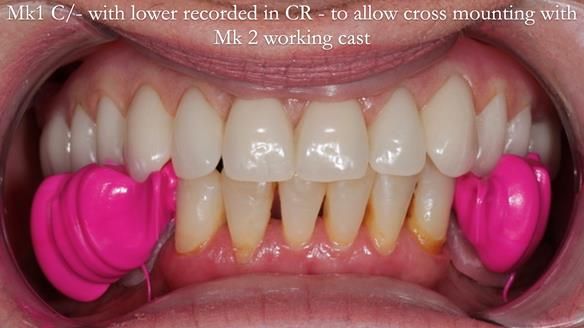 Newsletter 52 Managing Jo’s failing dentition with extractions and Mk 1/Mk 2 complete upper dentures and lower partial dentures FULL PROTOCOL