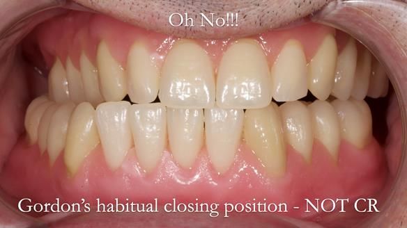 Newsletter 80 - Gordon’s dentures: the one case in 1,000 where my technique failed