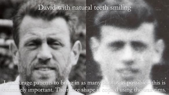 Newsletter 54 case presentation upper complete denture and lower Scandinavian designed hygienic partial denture for David