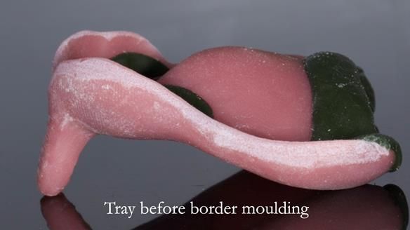 Newsletter 54 case presentation upper complete denture and lower Scandinavian designed hygienic partial denture for David