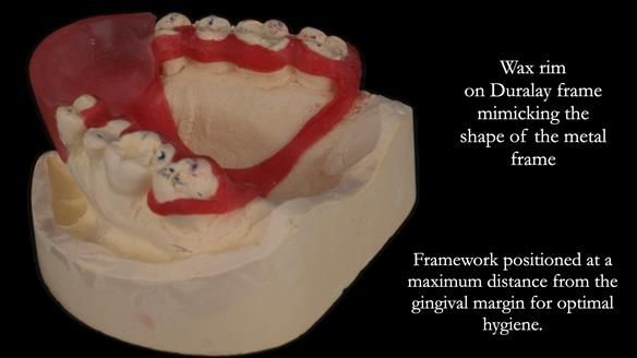 Finlay's Newsletter 64 case study - provision of a Kennedy class 2 metal based Scandinavian RPD for Ian