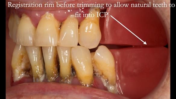 Finlay's Case Study Newsletter 40 - Immediate Mk 1 RPD to Definitive Mk 2 RPD - full protocol