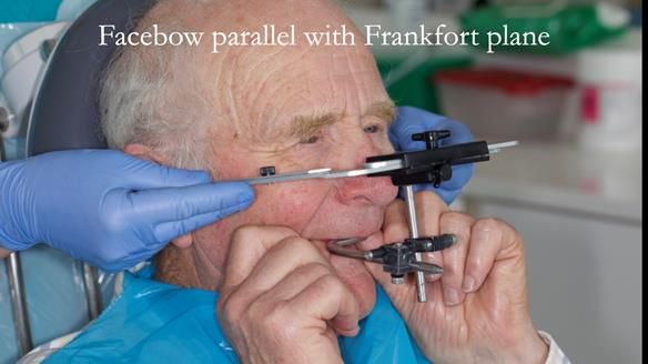 Complete denture Class II div 2 deep overbite Newsletter 39