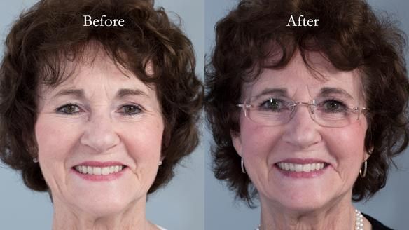 Newsletter 75: Marion’s case - Step-by-step complete denture workflow