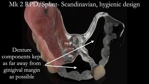 Newsletter 51 Managing Anne’s failing dentition with distal extension base RPD/Splint FULL PROTOCOL