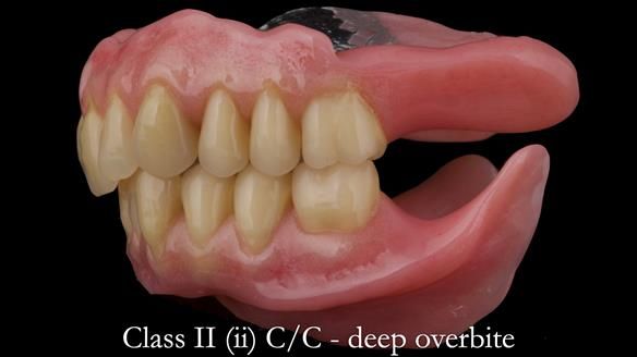 Complete denture Class II div 2 deep overbite Newsletter 39