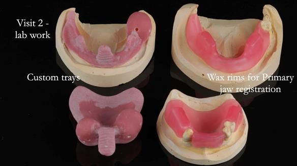 Finlay's Newsletter 59 Ultra hard partial dentures made for Gill