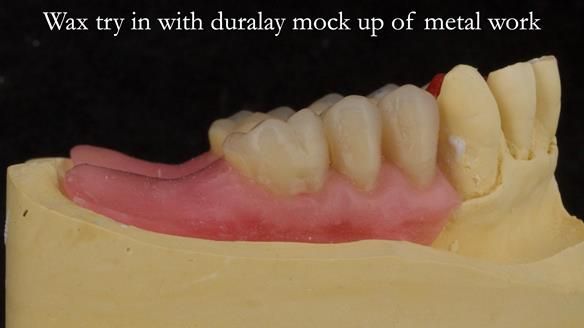 Finlay's Case Study Newsletter 40 - Immediate Mk 1 RPD to Definitive Mk 2 RPD - full protocol