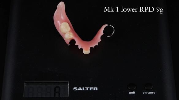 Newsletter 54 case presentation upper complete denture and lower Scandinavian designed hygienic partial denture for David