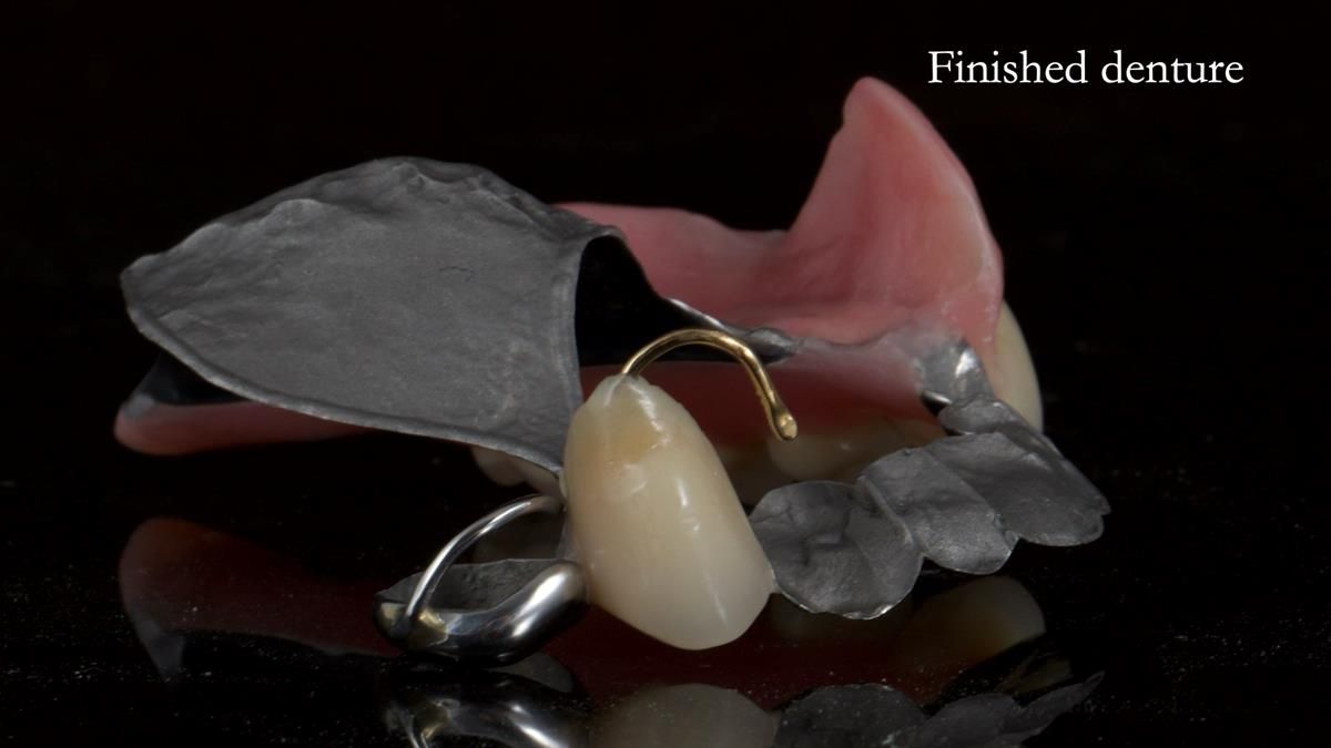 Newsletter 89 – Simon: A Challenging Kennedy Class II Division 1 Upper CoCr Partial Denture with a High Smile Line