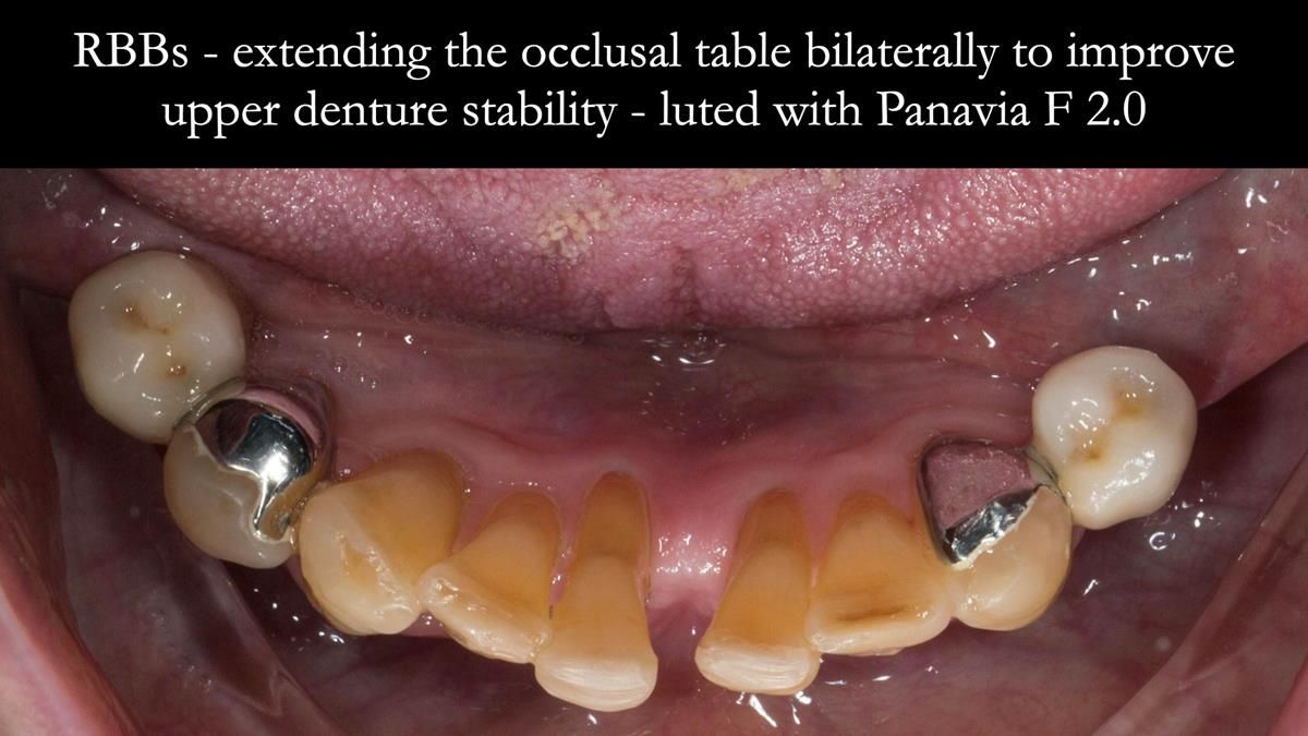Newsletter 87 – Father Peter: A Partial Denture that needed Minor Miracle