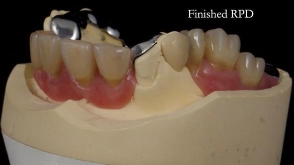 How Keith’s combat denture transformed his life – Newsletter 73