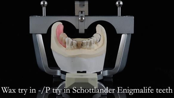 Newsletter 54 case presentation upper complete denture and lower Scandinavian designed hygienic partial denture for David