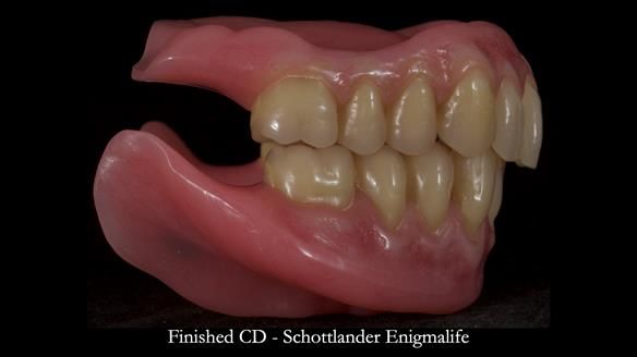 Newsletter 83: Sheila’s Complete Denture Success