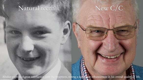 Newsletter 57 showcases the making and fitting process of implant-supported complete dentures for Alisdair