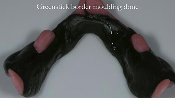 Newsletter 75: Marion’s case - Step-by-step complete denture workflow