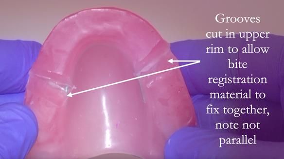 Finlay's Newsletter 62 provision of extractions and metal based complete dentures for Rafique