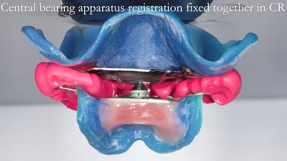 Newsletter 77: Jeremy’s case – immediate complete upper denture