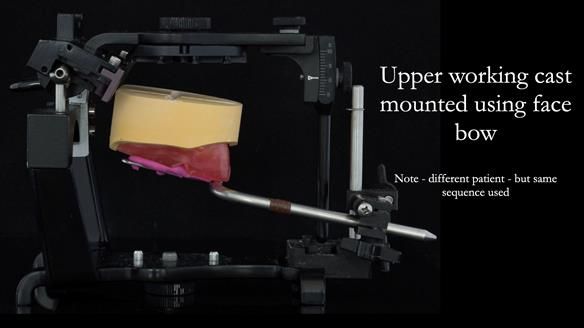 The working casts are detached from their bases which previously attached the articulator using the primary jaw registration. The upper work cast is fitted to the articulator using the bite fork