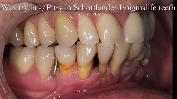 Newsletter 54 case presentation upper complete denture and lower Scandinavian designed hygienic partial denture for David
