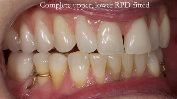 Solving Linda’s Failed “All on 4” implant bridges - full protocol Newsletter 42