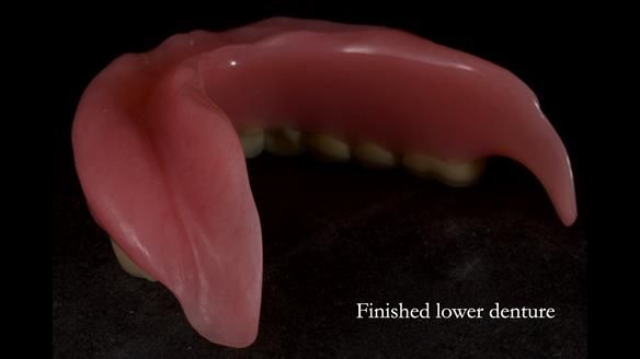 Newsletter 83: Sheila’s Complete Denture Success