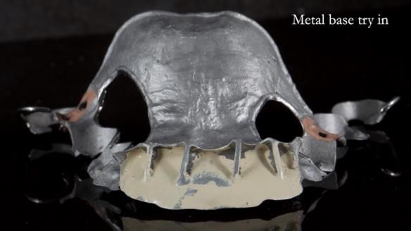Newsletter 81 - Pam’s Story — how a partial denture changed her life (+ live walkthrough this Thursday)