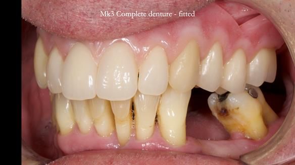Newsletter 77: Jeremy’s case – immediate complete upper denture