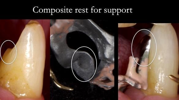 Newsletter 86 Peter the Architect — precision removable partial dentures case study