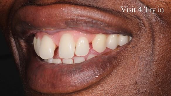 Newsletter 53 showing the making and fitting of ultra life-like dentures for Valena