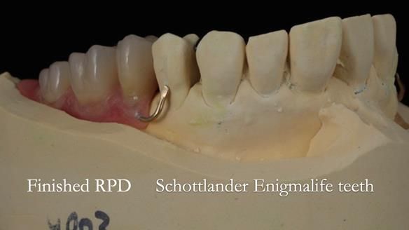 Newsletter 56 showing the making and fitting of a bilateral free end saddle upper removable partial denture (RPD) for patient with pemphigus
