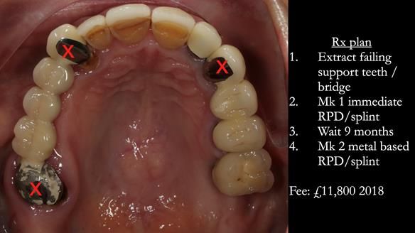Newsletter 51 Managing Anne’s failing dentition with distal extension base RPD/Splint FULL PROTOCOL