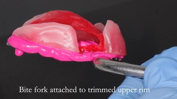 Finlay's Newsletter 59 Ultra hard partial dentures made for Gill