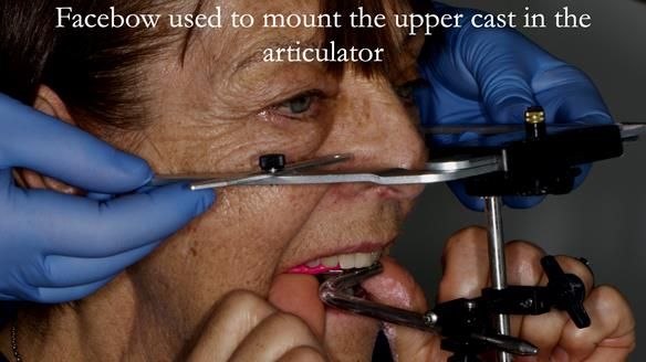 Finlay's Newsletter 61 provision of a lower unilateral free end saddle metal based partial denture for Joyce