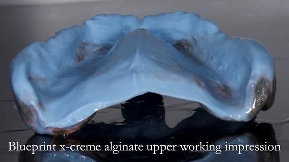 Newsletter 80 - Gordon’s dentures: the one case in 1,000 where my technique failed