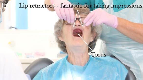 Solving Linda’s Failed “All on 4” implant bridges - full protocol Newsletter 42