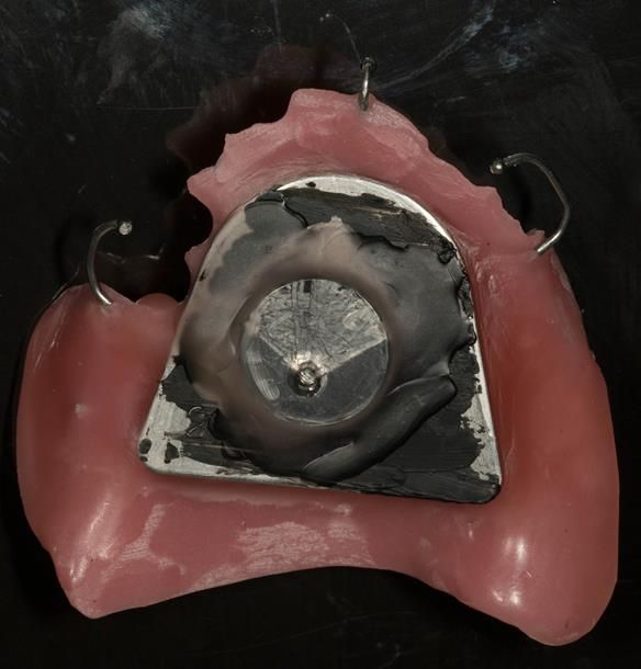 Figure 23 Inter-maxillary registration with central bearing apparatus. Maxillary plate with plastic disc with countersunk hole placed over CR arrow head. This allows the mandibular pin to fit into the hole to enable accurate recording of this inter-maxill